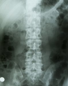 x-ray of human's lower back
