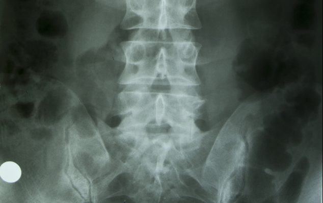 xray of the lower back