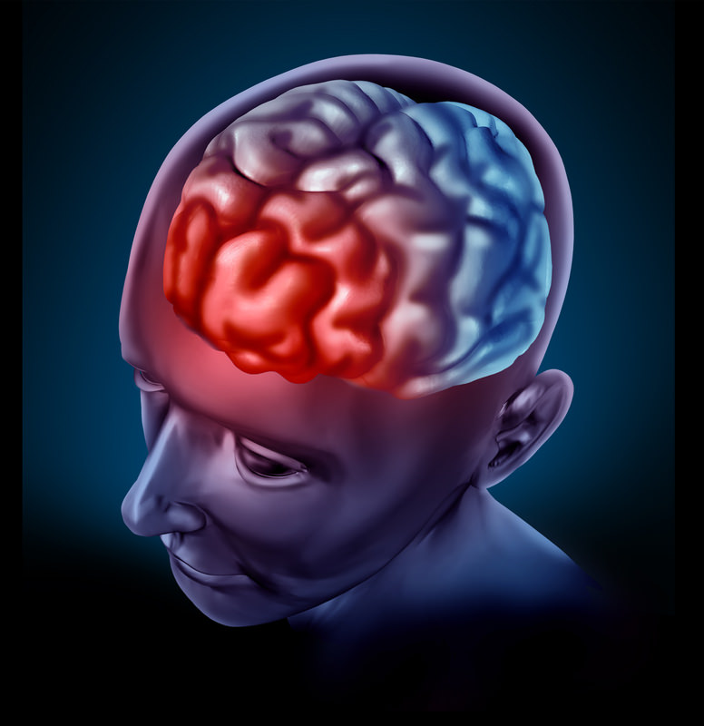 a picutre of a human brain with teh area of migraine pain highlighted