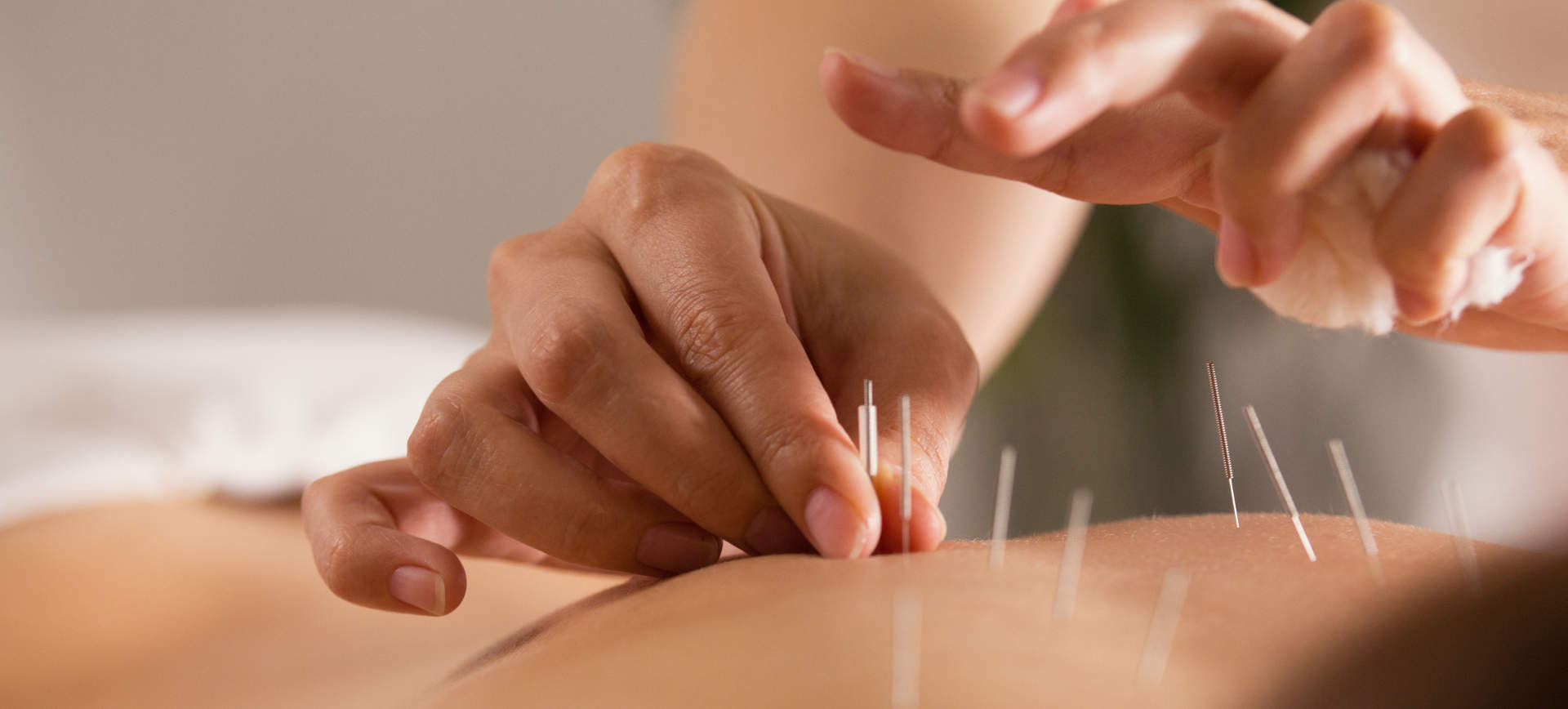 Acupuncture in Mountain View