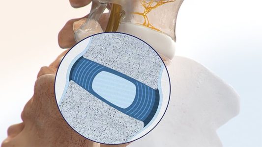 Normal Disc