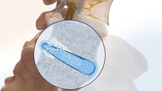 Inflamation of disc