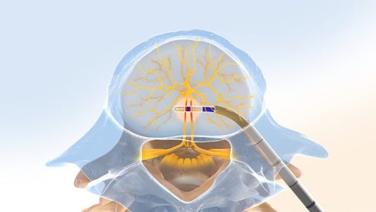 Step 4 of Intracept® Procedure