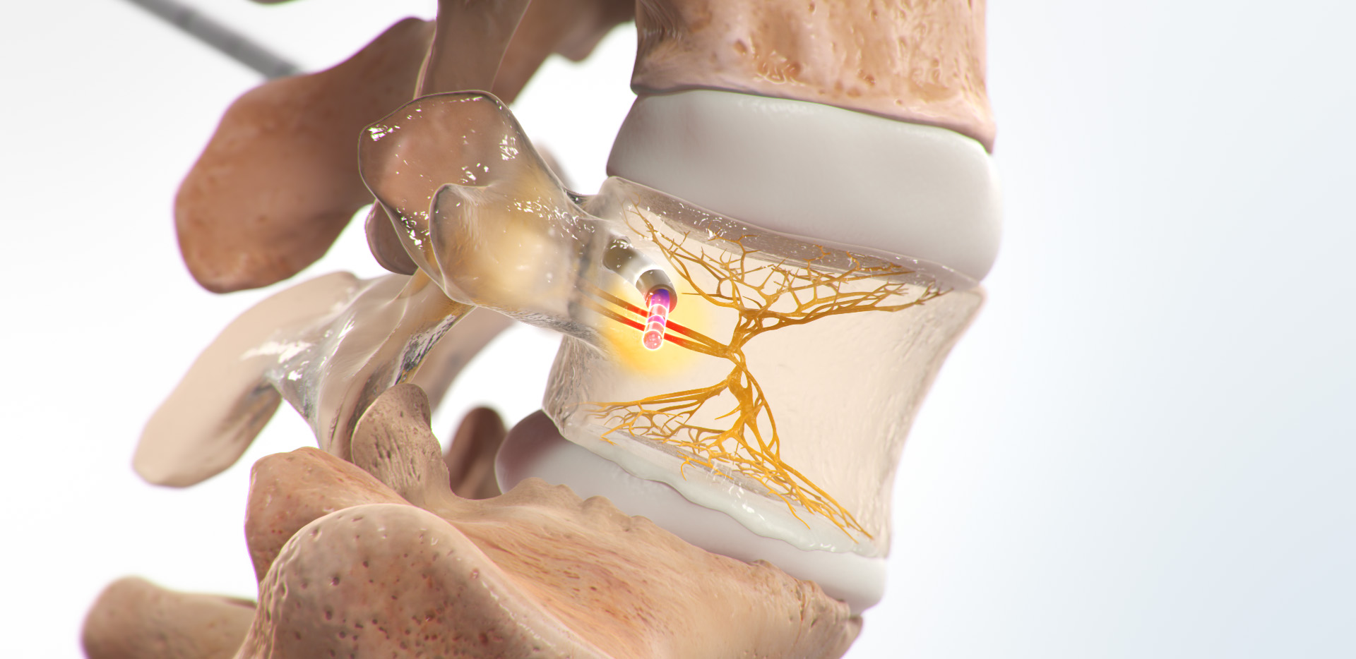 Intracept Procedure in San Jose and Los Gatos